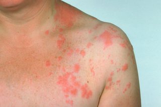 Shingles rash